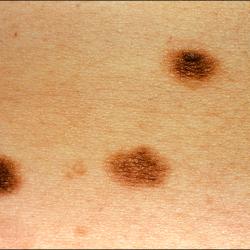 Example of moleRemoval